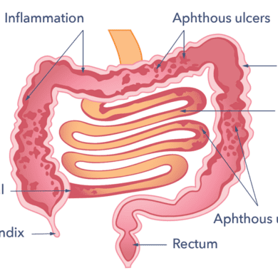 A diagram of the small and large intestine. Labelled are inflammation, aphthous ulcers, large bowel, small bowel, aphthous ulcers, rectum, appendix and terminal ileum