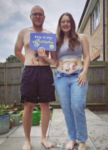 Sian and Matt are smiling at the camera with Guts UK's temporary #GUTSelfie tattoos on their bellies. Sian is holding a blue #GUTSelfie board in front of Matt's chest. They are stood in their garden.