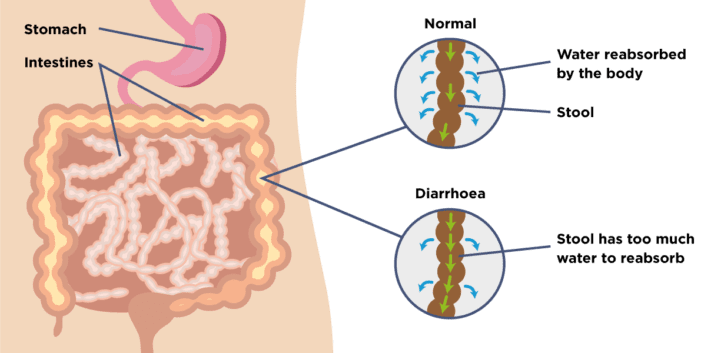 diarrhoea causes symptoms treatment support guts uk