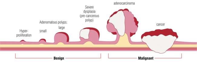 Bowel cancer - Guts UK