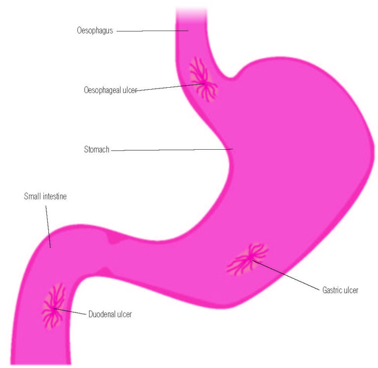 Helicobacter pylori - Guts UK