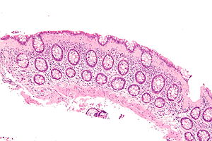 A cell biopsy which is a tissue sample from the bowel showing collagenous colitis.