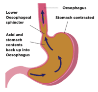 Barrett's Oesophagus - Guts Uk