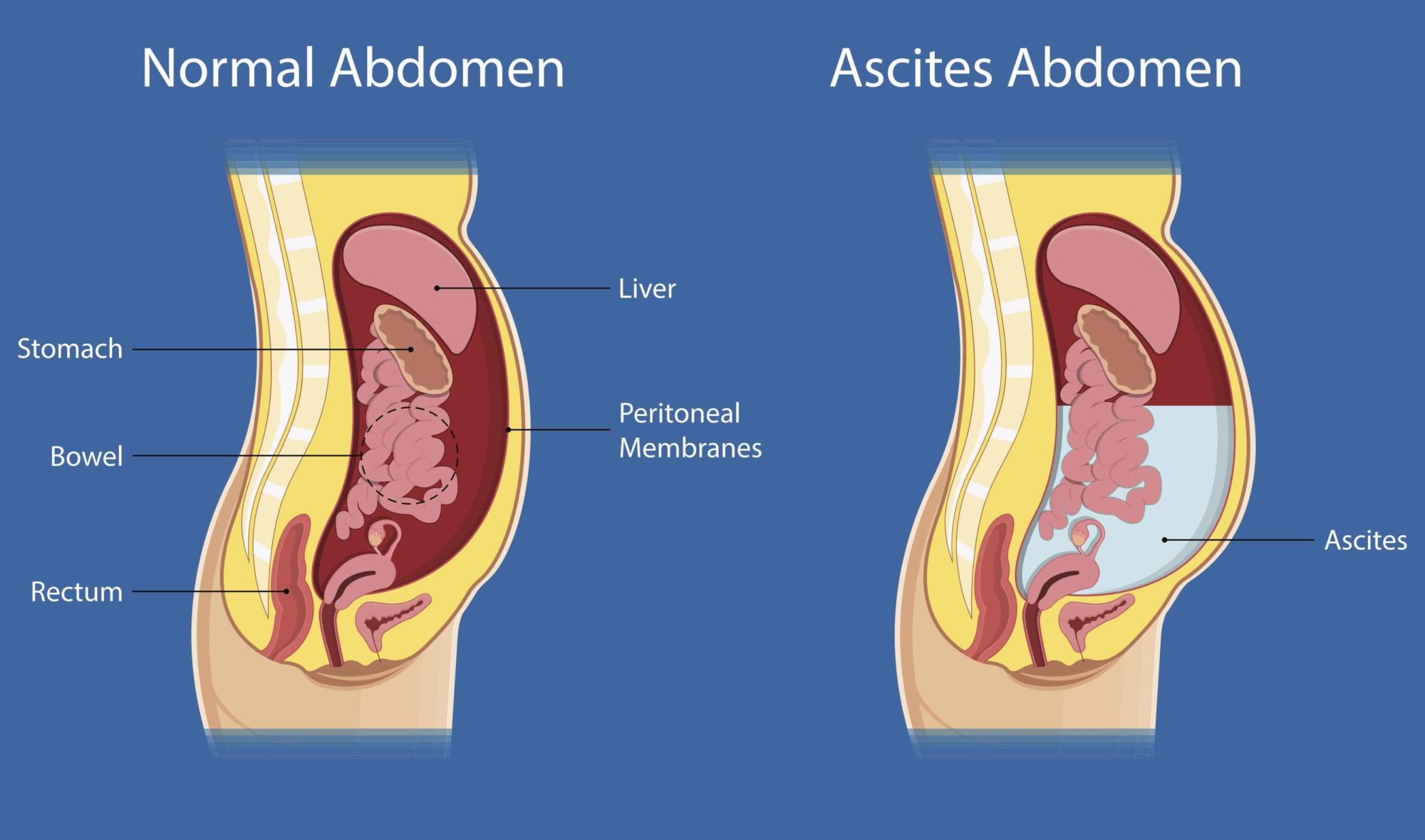 Ascites Guts UK