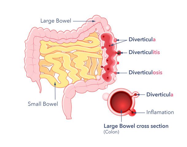 Diverticulosis around the world - Guts UK