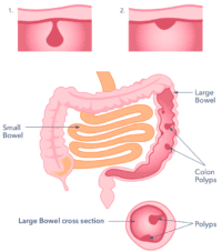 Polyps in the bowel - Guts UK