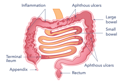 Crohn's Disease | Causes, Symptoms, Treatment & Support | Guts UK