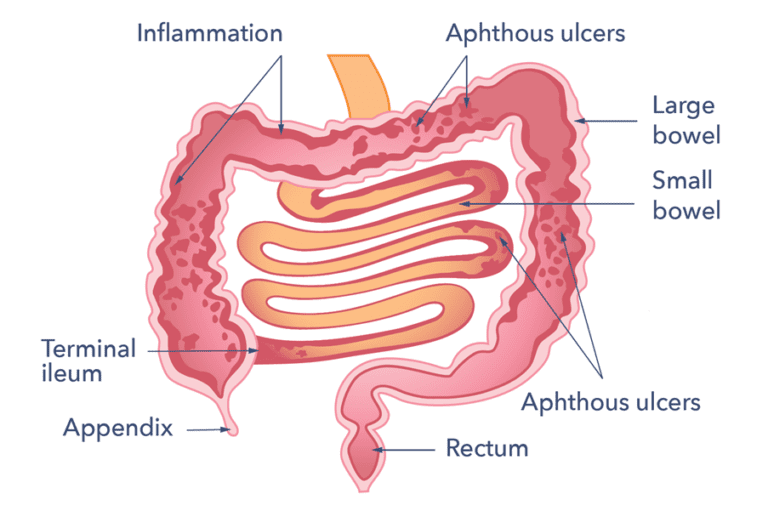 Crohn's Disease | Causes, Symptoms, Treatment & Support | Guts UK