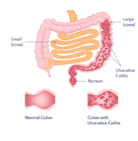 Ulcerative Colitis | Causes, Symptoms, Treatment & Support | Guts UK