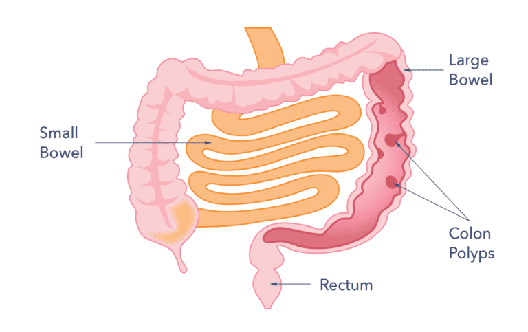 Bowel (Colon) Cancer | Causes, Sympoms, Effects & Treatment | Guts UK