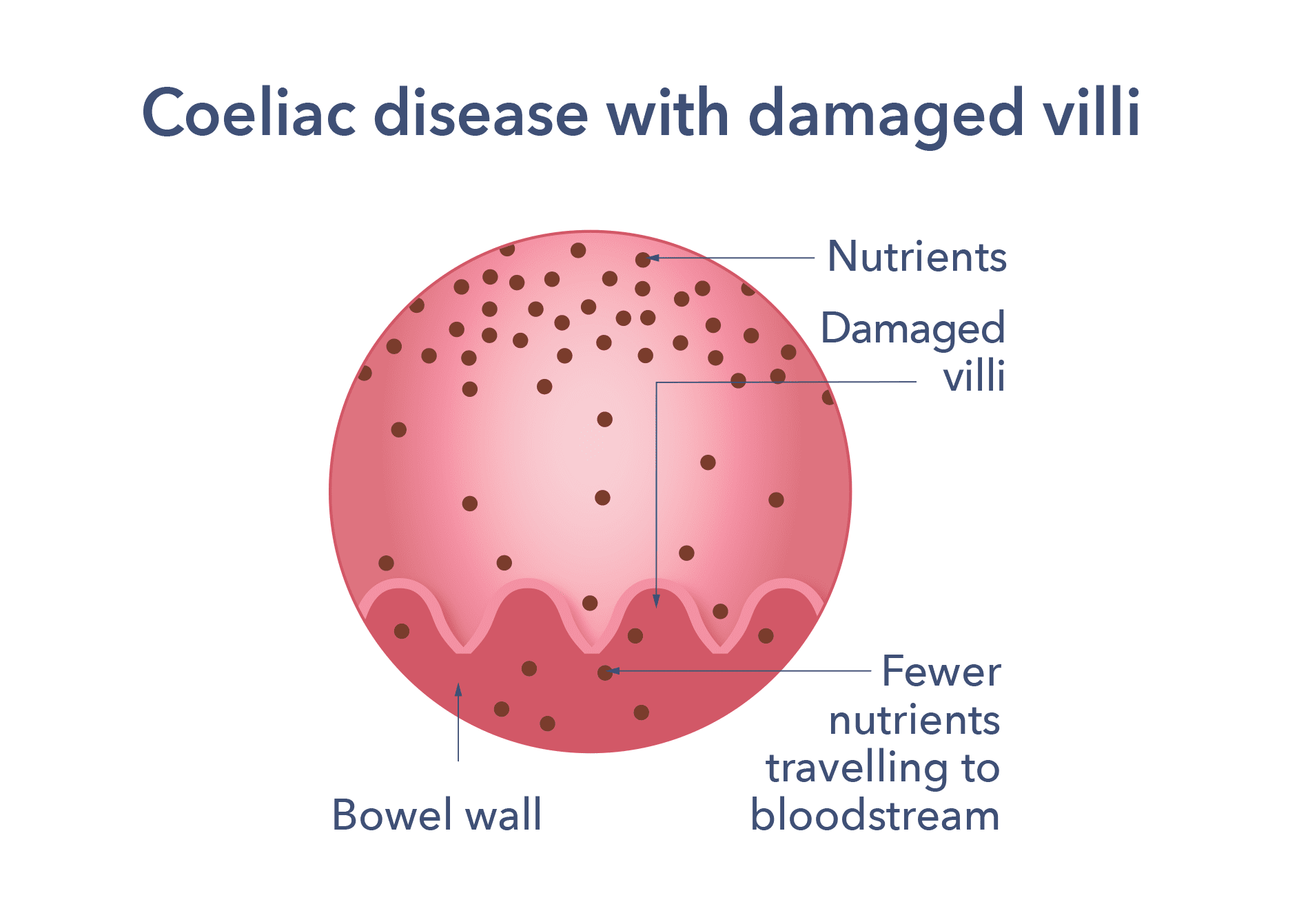 coeliac-disease-causes-symptoms-treatment-support-guts-uk