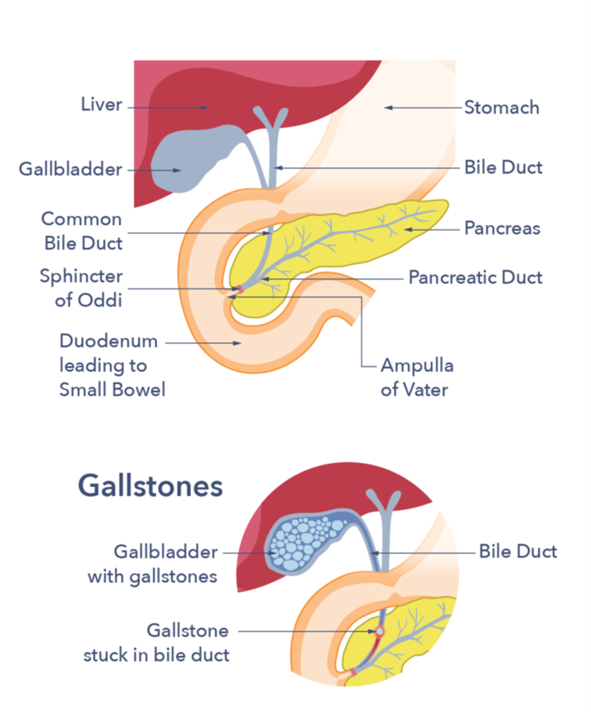 First image shows a close up of the digestive system. From top left down: liver, gallbladder, common bile duct, sphincter of oddi, duodenum leading to the small bowel. Top right down: stomach, bile duct, pancreas, pancreatic duct, ampulla of vater. Second image is an up close image of gallstones, showing stones in the gallbladder.