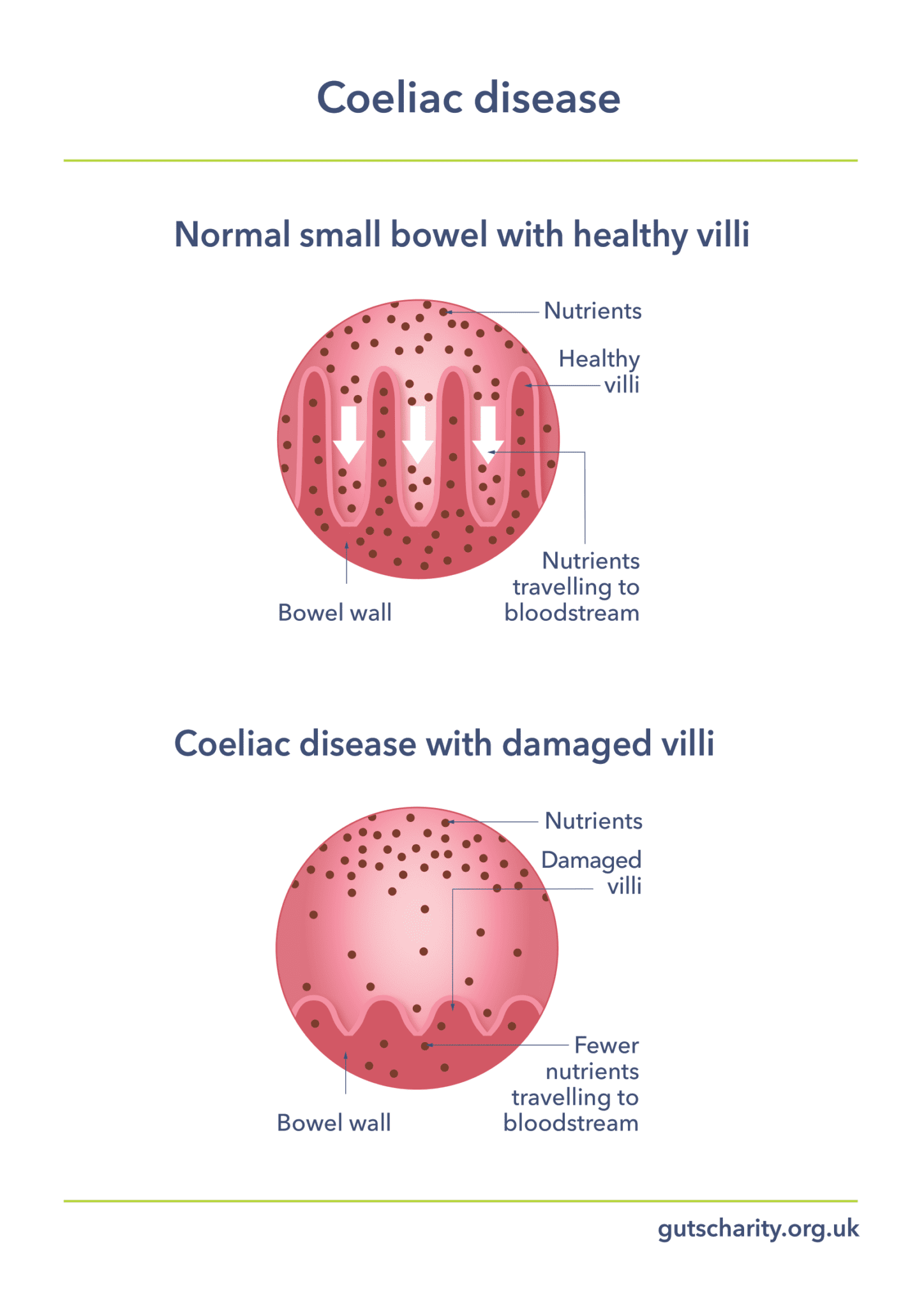 Coeliac Disease Awareness Week 2023 Guts UK