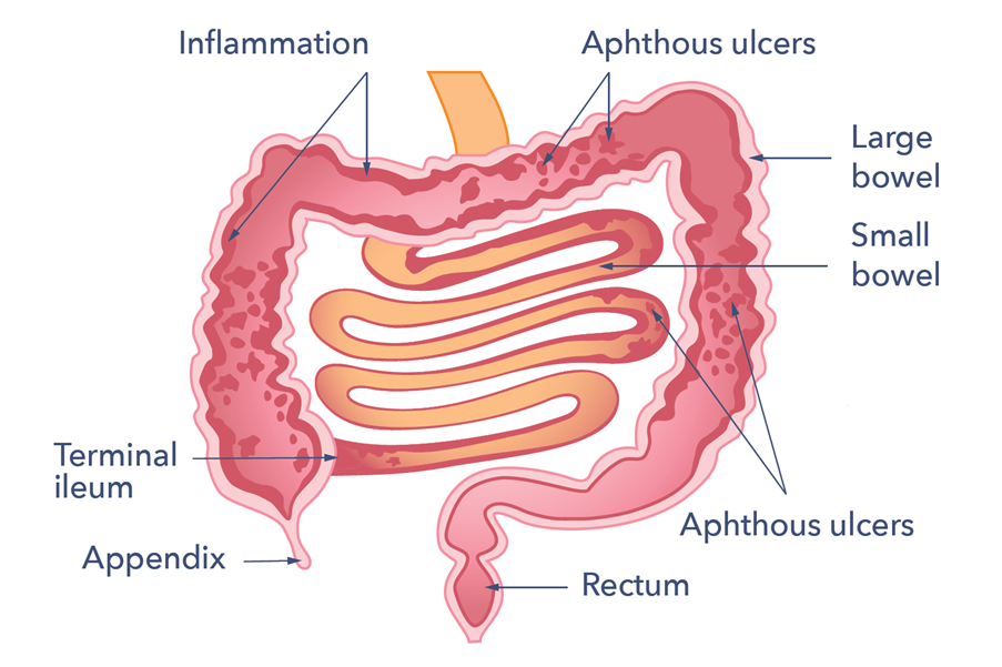 A diagram of the small and large intestine. Labelled are inflammation, aphthous ulcers, large bowel, small bowel, aphthous ulcers, rectum, appendix and terminal ileum