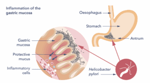 A diagram showing infection with Helicobacter pylori, causing inflammation of the gastric mucosa.