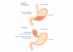 An illustration showing the difference between the way a healthy oesophagus digests food and an oesophagus affected by achalasia.