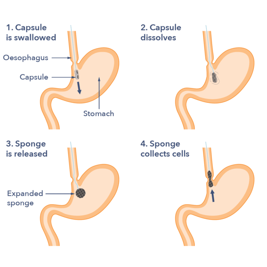 A diagram of the stomach and oesophagus, receiving a capsule sponge test. The diagram shows four stages: 1. Capsule is swallowed, 2. Capsule dissolves, 3. Sponge is released, 4. Sponge collects cells.